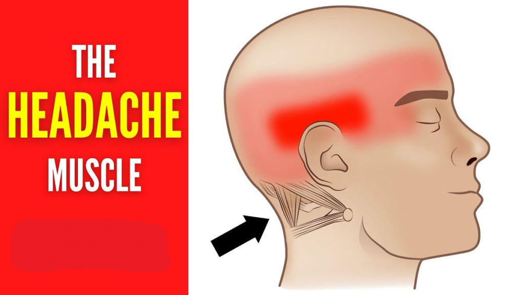 alt_headache muscle